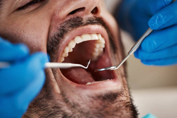 Best Emergency Treatment for Dental Infections or Abscesses in Purdy, WA